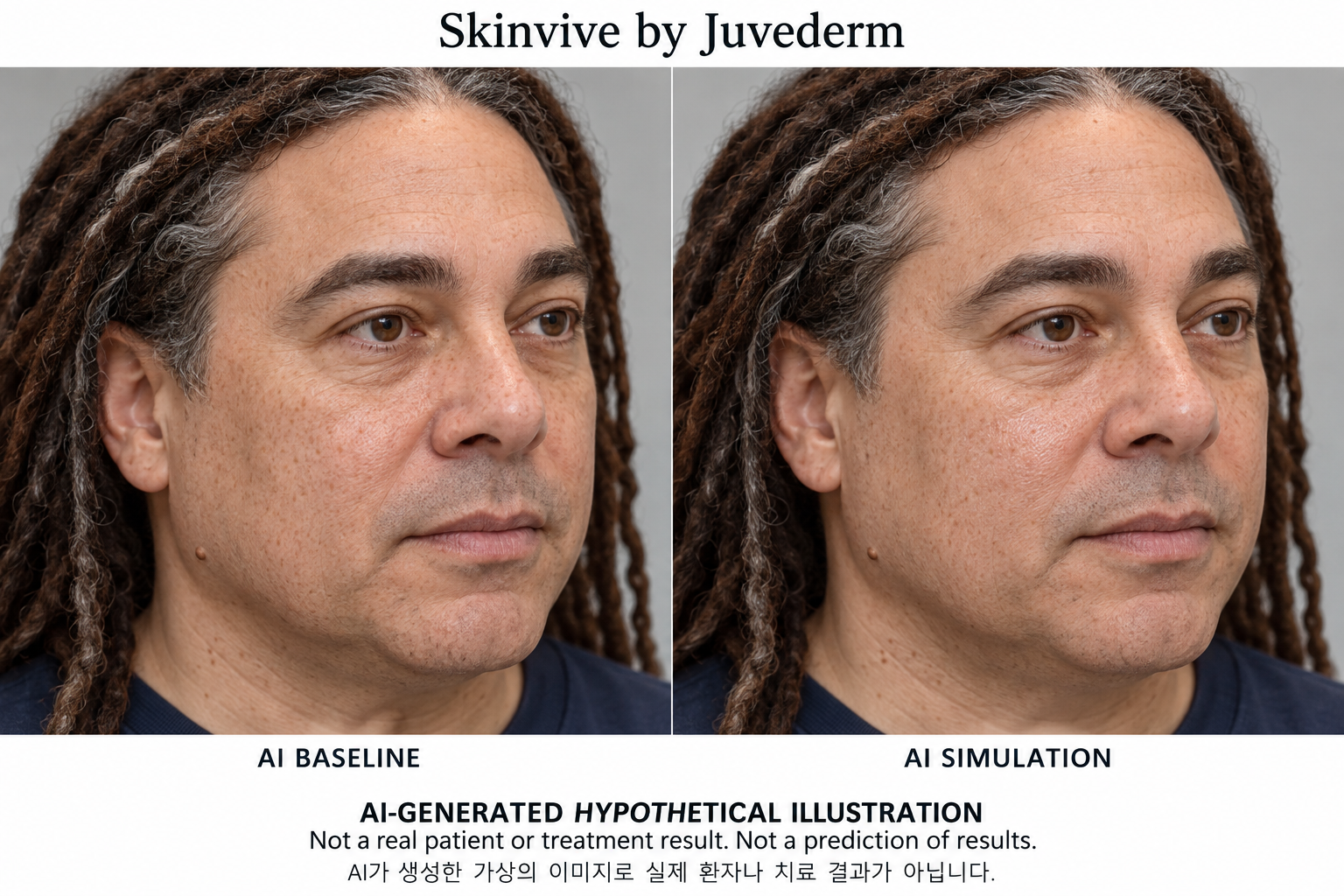 Fictional AI illustration; not an actual patient, result or prediction — Skinvive by Juvéderm
